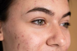 Every Face Instituut - Huidkliniek voor Mesotherapie, microneedling & meer