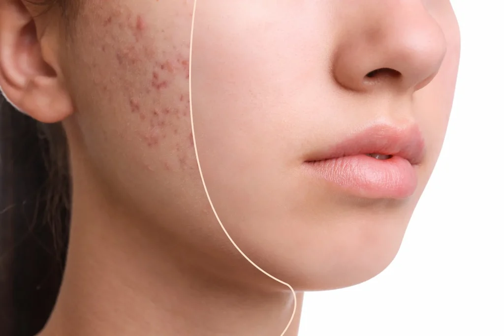 Huidkliniek Groningen - Acne Littekens